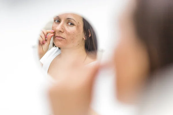 Photo Une Femme Ayant Des Problèmes Peau Regardant Dans Miroir — Photo