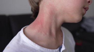 Çocukların boynunda ve yüzünde alerjik deri reaksiyonu. Kızarıklık. Fotodermatit belirtileri. Güneş ışığına alerjik reaksiyon. 