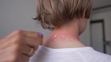 Fotodermatitin belirtileri olarak boynun derisinde kırmızı kabarcıklar ve vezikler var. Güneş ışığına alerjik reaksiyon. Anne çocukların boynunu ovuyor.