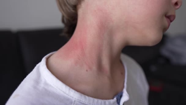 Reazione allergica cutanea sul collo e sul viso dei bambini eruzione cutanea rossa. Sintomi di fotodermatite. Reazione allergica alla luce solare. — Video Stock