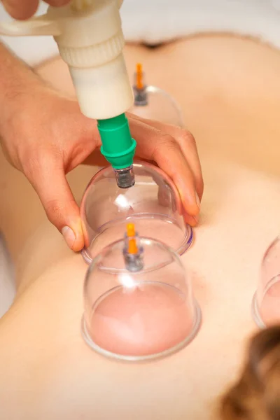 Acupuntura Terapeuta Mujer Colocando Taza Espalda Una Paciente Femenina — Foto de Stock