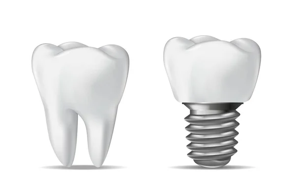 Human Tooth Dental Implant Dental Concept Realistic Vector Illustration White —  Vetores de Stock