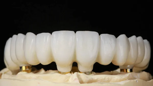 Macro Foto Uma Prótese Dentária Feita Materiais Alta Qualidade — Fotografia de Stock