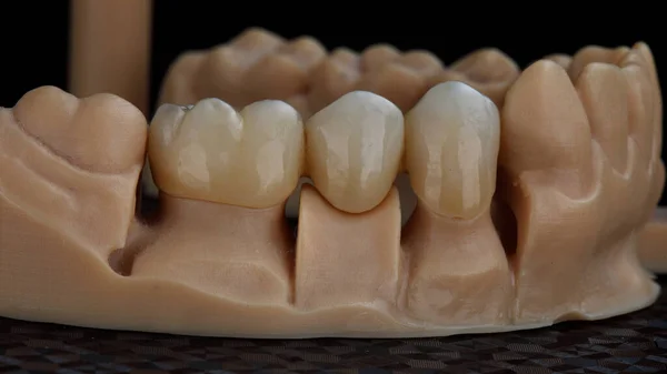 Τρεις Μεγάλες Οδοντικές Κορώνες Ένα Ειδικό Μοντέλο Σαγόνι — Φωτογραφία Αρχείου