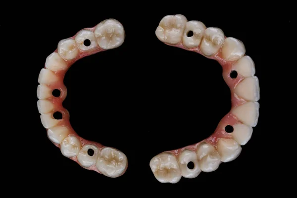 Dental Ceramics Prostheses Upper Lower Jaws Top View Black Background — Stock Photo, Image