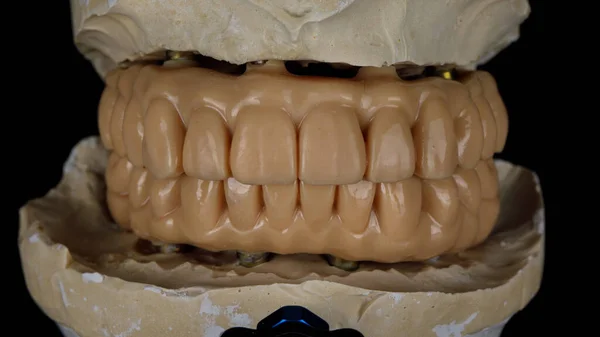 Tandprothesen Voor Patiënt Prothesen Beet Het Model — Stockfoto