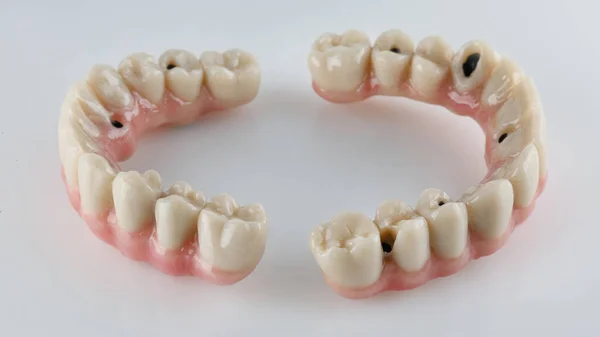 Ceramiczne Protezy Dentystyczne Belce Tytanowej Górną Dolną Szczękę Białym Tle — Zdjęcie stockowe
