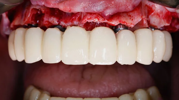Προσωρινή Προσθετική Οδοντοστοιχία Μεταλλικές Δοκούς Τοποθέτηση Μετά Από Μείωση Των — Φωτογραφία Αρχείου