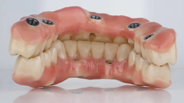 Ceramic Prostheses Whole Jaw Bite White Background View — Stock Photo, Image