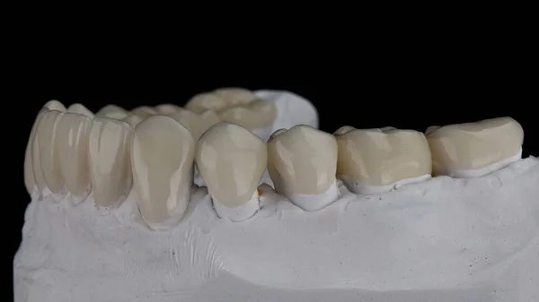 Ceramiczne Korony Dentystyczne Modelu Gipsowym Czarnym Tle — Zdjęcie stockowe