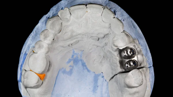 石膏の顎モデルと二つのチタン製のアバットメント — ストック写真