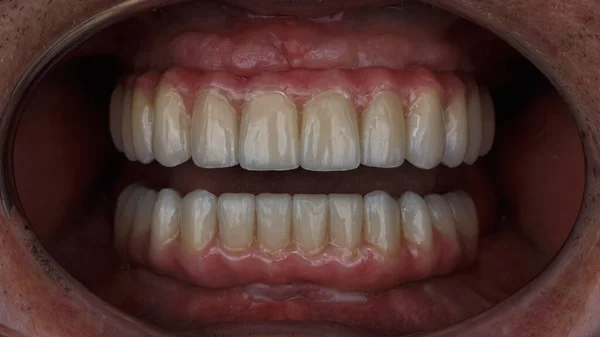 Όμορφη Σύνθεση Στην Εγκατεστημένη Κεραμική Οδοντοστοιχία Της Άνω Και Κάτω — Φωτογραφία Αρχείου