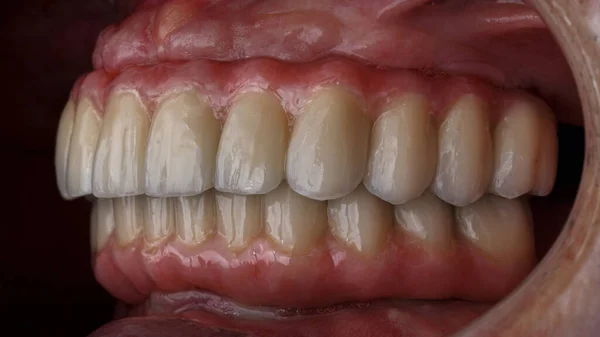口腔内の口の中の上顎と下顎のセラミック歯科矯正 ビューから — ストック写真