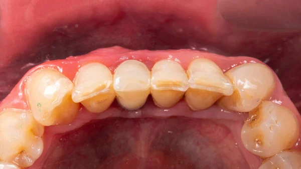 Έφιππη Οδοντιατρική Κορώνα Κεντρική Κάτω Από Δόντι Σαγόνι — Φωτογραφία Αρχείου