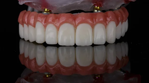 Mandíbulas Superiores Protéticas Dentárias Temporárias Feixe Modelo Fundo Preto Com — Fotografia de Stock