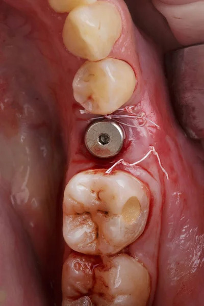 噛む歯の分野に歯科インプラント及び歯茎の形状を設置 — ストック写真