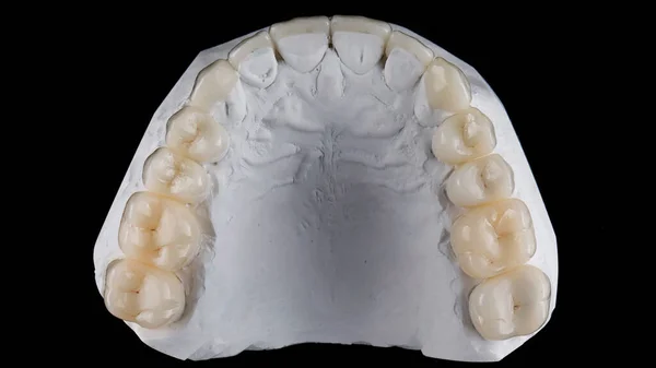 Керамические Коронки Гипсовых Моделях Вид Сверху Черном Фоне — стоковое фото