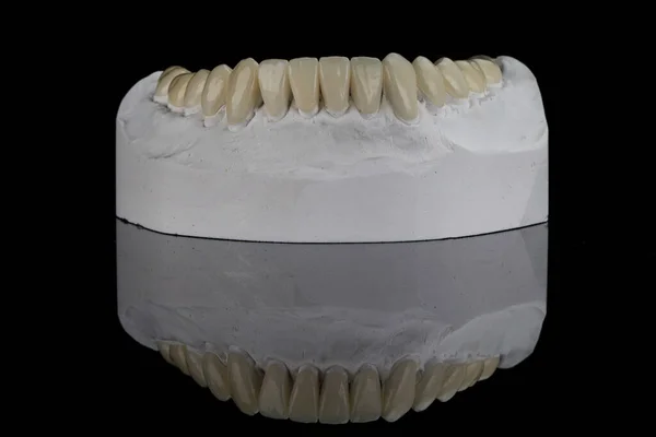 Corone Dentali Ceramica Alta Qualità Sul Modello Della Mascella Inferiore — Foto Stock