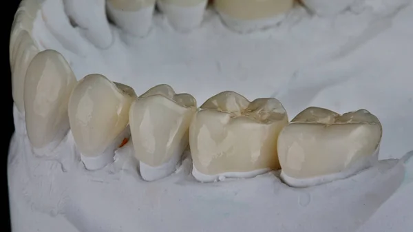 Bela Foto Coroas Dentárias Dentes Mastigando Modelo Mandíbula — Fotografia de Stock