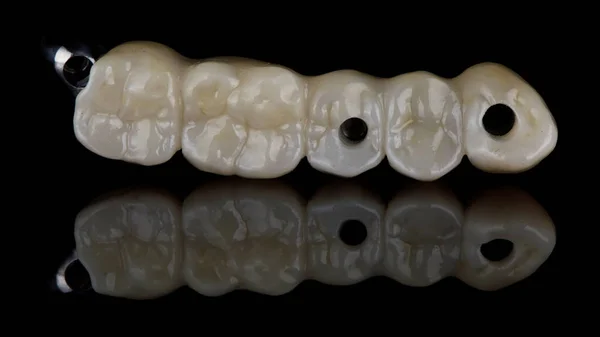 Dental Bridge Five Zircon Dioxide Teeth Titanium Beam Black Background — Stock Photo, Image