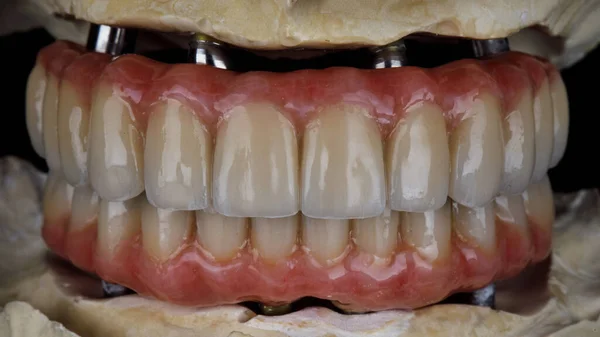 石膏モデルの上顎と下顎のためのセラミックからピンクの歯茎を持つプロテーゼ — ストック写真