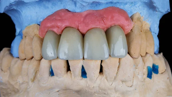 Mplantasyondan Sonra Dört Merkezi Kesici Dişin Diş Kaplaması Değiştirilmesi — Stok fotoğraf