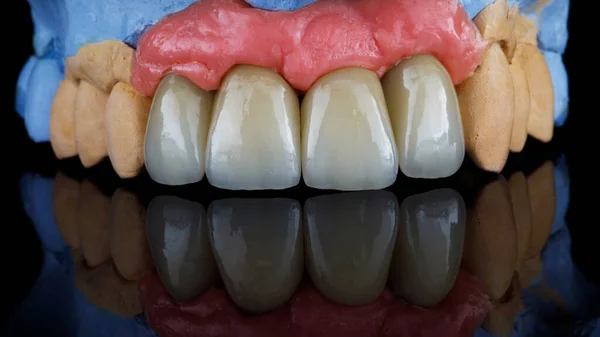 Cuatro Coronas Dentales Alta Calidad Después Implantación Disparadas Sobre Vidrio —  Fotos de Stock