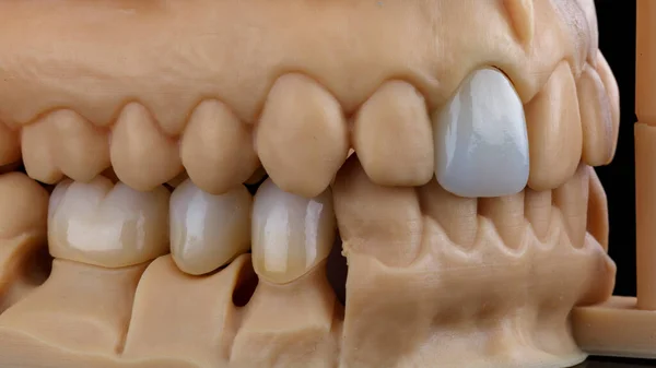 Превосходный Состав Стоматологических Моделей Керамическими Коронками Высокого Качества — стоковое фото