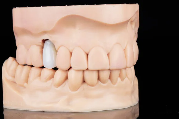 Siyah Arka Planda Çiğnenmiş Diş Kaplaması Olan Bir Diş Modeli — Stok fotoğraf