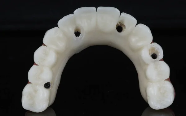 上顎の一時的な歯科補綴物トップビュー — ストック写真