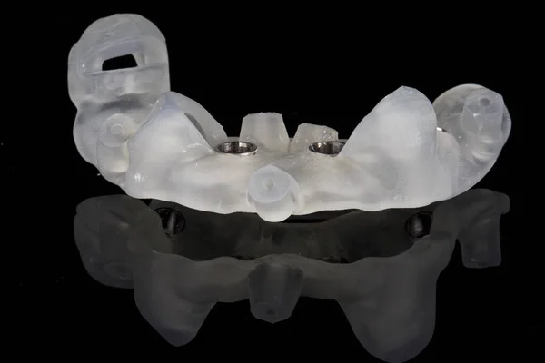 Modelo Dental Descansando Sobre Dente Pacientes Para Implantação Tiro Uma — Fotografia de Stock