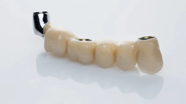 Ceramic Dental Bridge Five Teeth Titanium Basis Orthopedic Surrender Shot — Stock Photo, Image