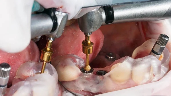 Daha Sonra Yerleştirmek Için Cerrahi Şablon Kullanan Elmas Boncuklu Diş — Stok fotoğraf