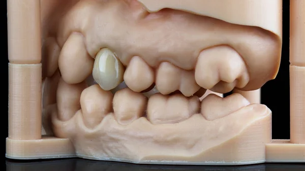歯冠は噛んだ時のモデルで黒の背景に優れた構図 — ストック写真