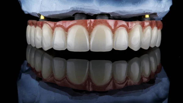 Prótese Dentária Temporária Alta Qualidade Para Mandíbula Inferior Disparada Vidro — Fotografia de Stock