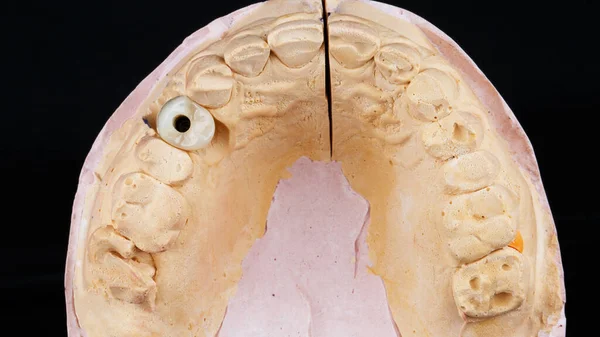 Korona Modelu Gipsu Precyzyjnego Przeniesienia Jamy Ustnej Pacjenta — Zdjęcie stockowe