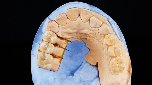 Drie Keramiek Kronen Een Gips Model Detail Van Bovenaf Geschoten — Stockfoto