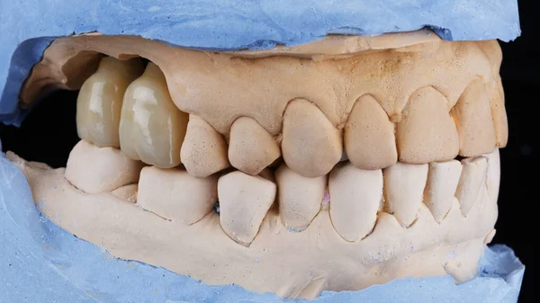 Modelo Dentário Mandíbula Duas Coroas Alta Qualidade Dentes Mastigadores — Fotografia de Stock