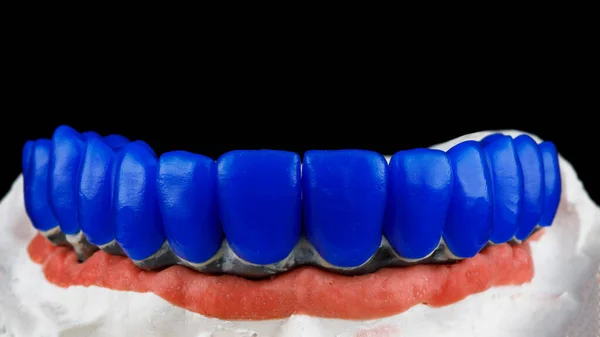 Denti Cera Trave Titanio Con Modello Dentale Gomma Rosa — Foto Stock