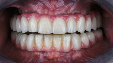 Hastanın ağız boşluğunda pembe sakızlı diş protezleri var.