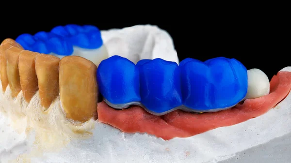 Podstawa Stomatologiczna Niebieskie Zęby Wosku Dentystycznego Montażu Kształtu Honorze Żucia — Zdjęcie stockowe