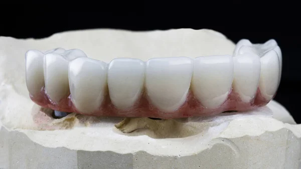 Temporary Dental Prosthesis Upper Jaw Prosthetics Plaster Model Black Background — Stock Photo, Image