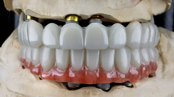 Diş Protezleri Siyah Arka Planda Taraftan Çekilen Alçı Modelinin Isırığındaki — Stok fotoğraf