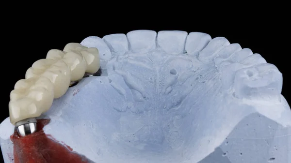 Pieza Masticación Protésica Temporal Dental Hecha Polímero —  Fotos de Stock