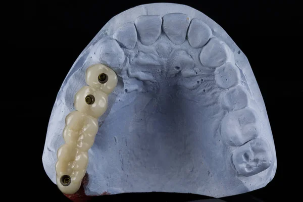 Dentalmodell Aus Gips Und Eine Provisorische Prothese Aus Polymer Dentalkunststoff — Stockfoto