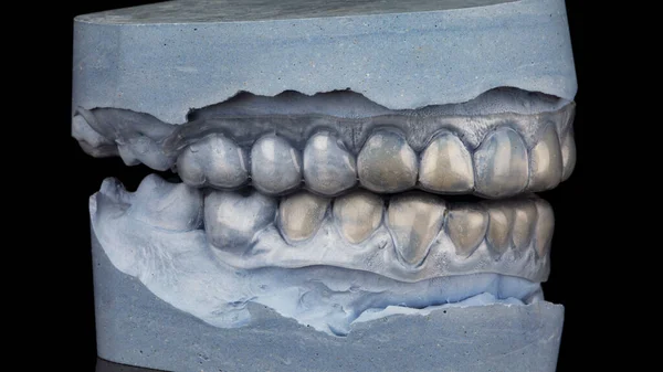 上顎と下顎の歯のキャップに石膏の模型があり黒い背景で撮影されています — ストック写真