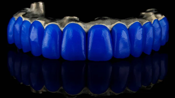 Tandtechnische Met Tanden Van Tandtechnische Waspreparaten Voor Vervaardiging Van Tandprothesen — Stockfoto