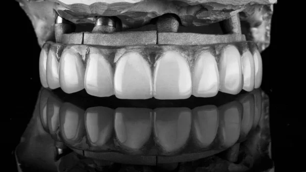 Excellent Composition Upper Jaw Prosthesis Model Special Metal Beam Shot — Stock Photo, Image