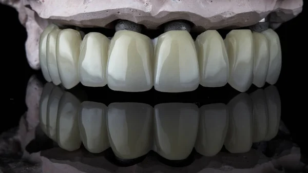 Prótese Dentária Temporária Mandíbula Superior Feita Cortador Moagem Polímero Modelo — Fotografia de Stock