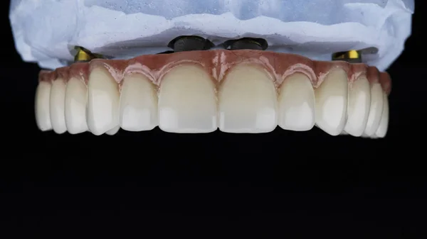 黒の背景に撮影された石膏のモデルにピンクのガムと上顎の歯科補綴物 — ストック写真